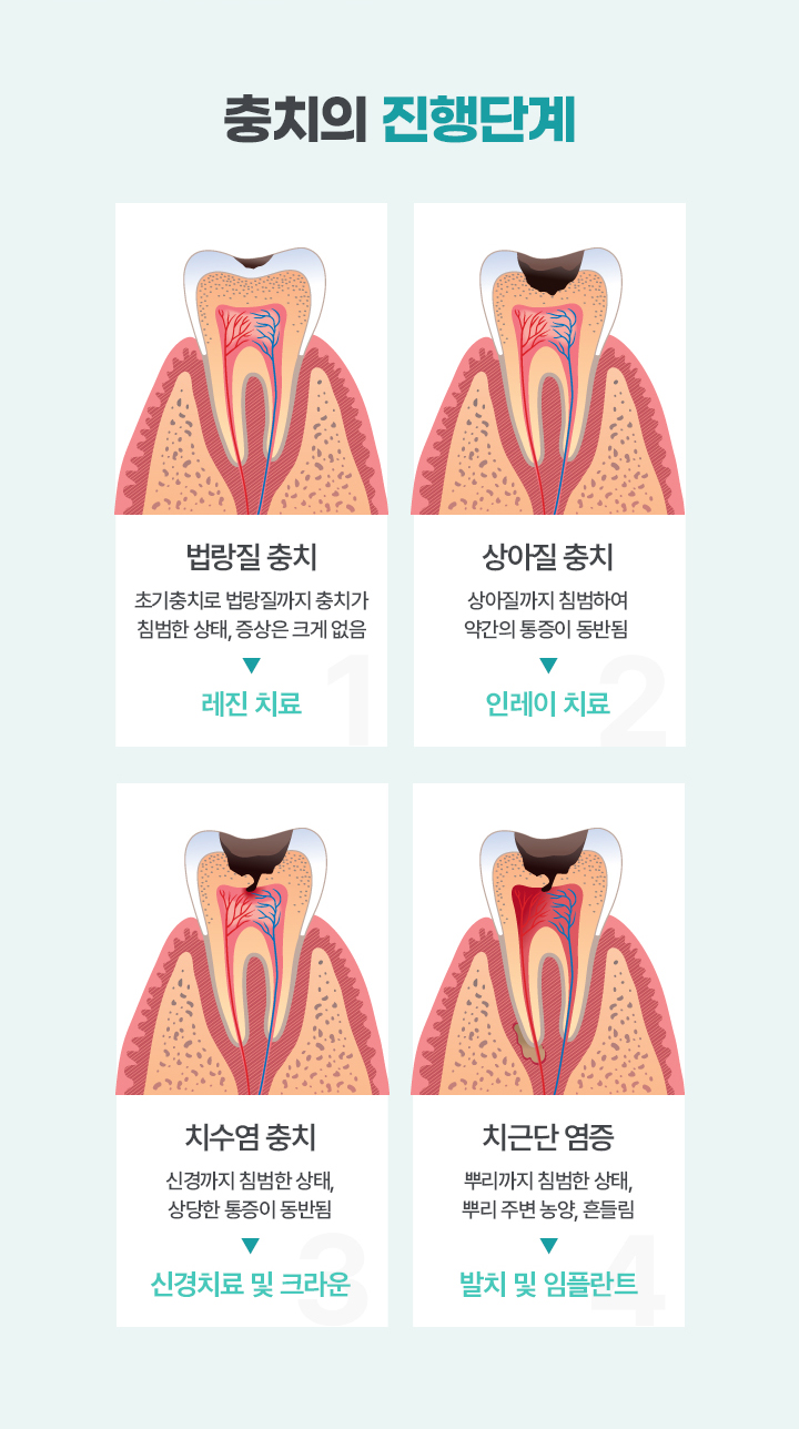 충치의 진행단계