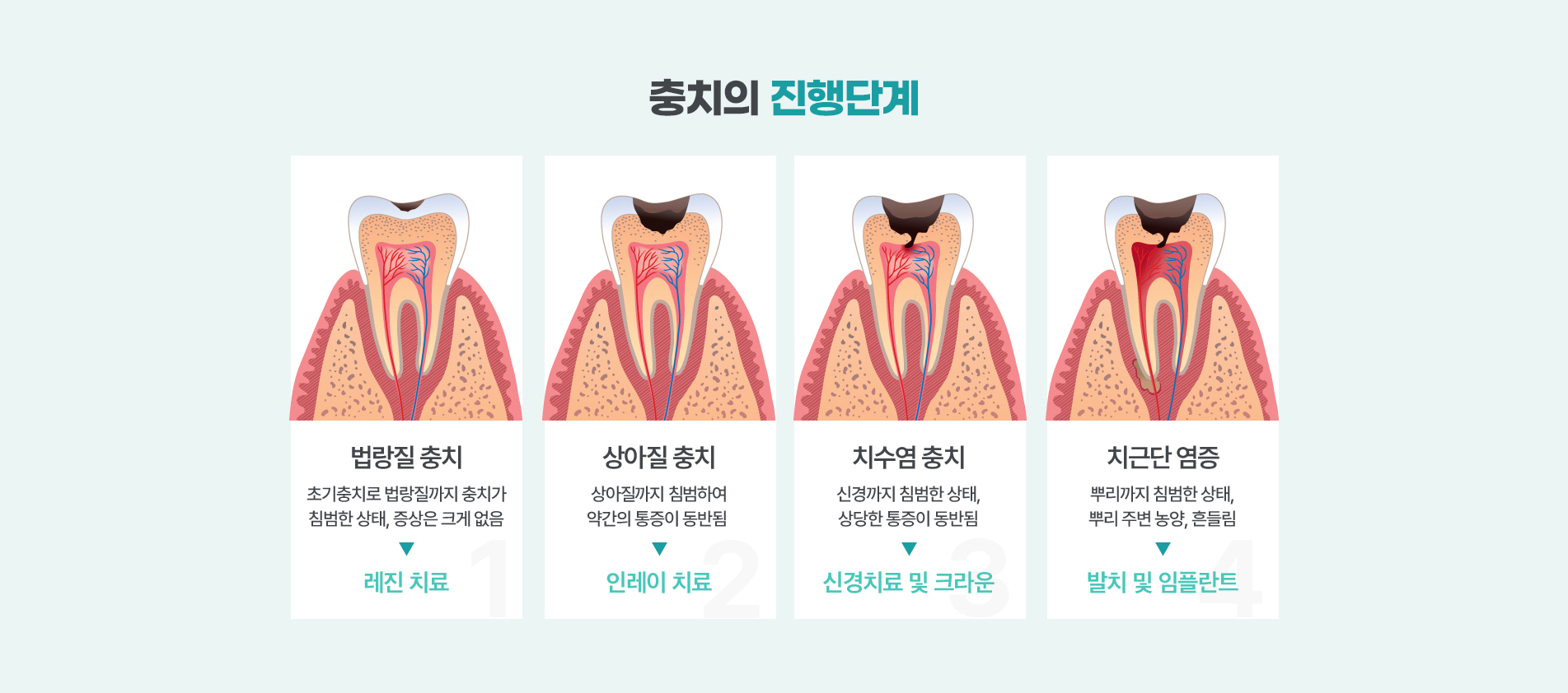 충치의 진행단계